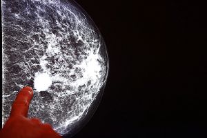 X-ray mammogram image of an affected breast with cancer. A finger is pointing at the white spot visible in the x-ray.