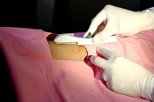 Contraceptive implant on a woman