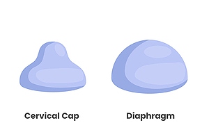 Two similar barrier contraception