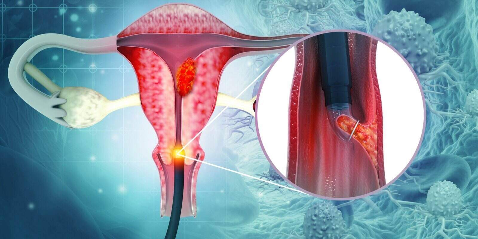 endometrial biopsy cervical cancer