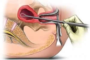 endometrial biopsy for tbpcr