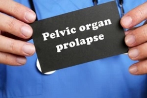 doctor holding black plate of pelvic organ prolapse