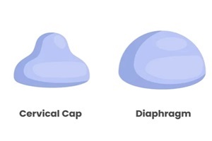 diaphram and cervical caps representing different types of barrier methods