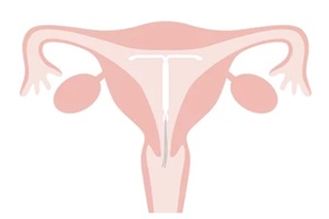 vagina diagram with IUD inserted