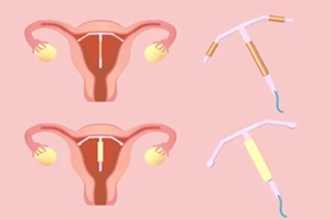 intrauterine device - IUD vector illustration