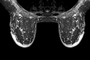 BI-RADS 4 in women indicates suspicious findings warranting