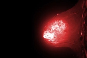 breast MRI revealing BI-RADS 4