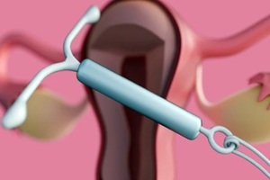3D rendering of a cross-sectional view of the female reproductive system featuring an Intrauterine Device or IUD